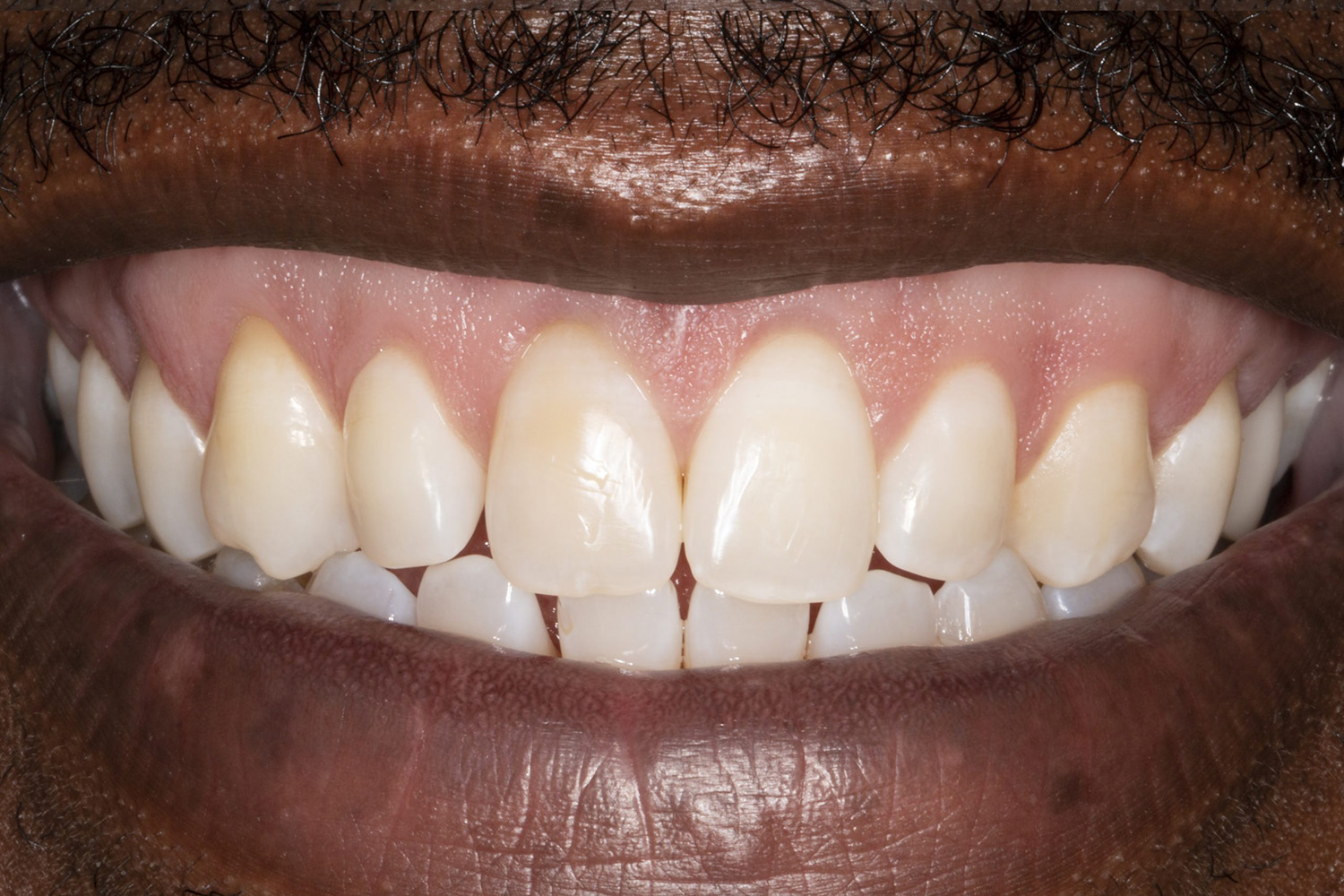 Close-up of a dark-skinned person smiling, showing healthy white teeth and gums.