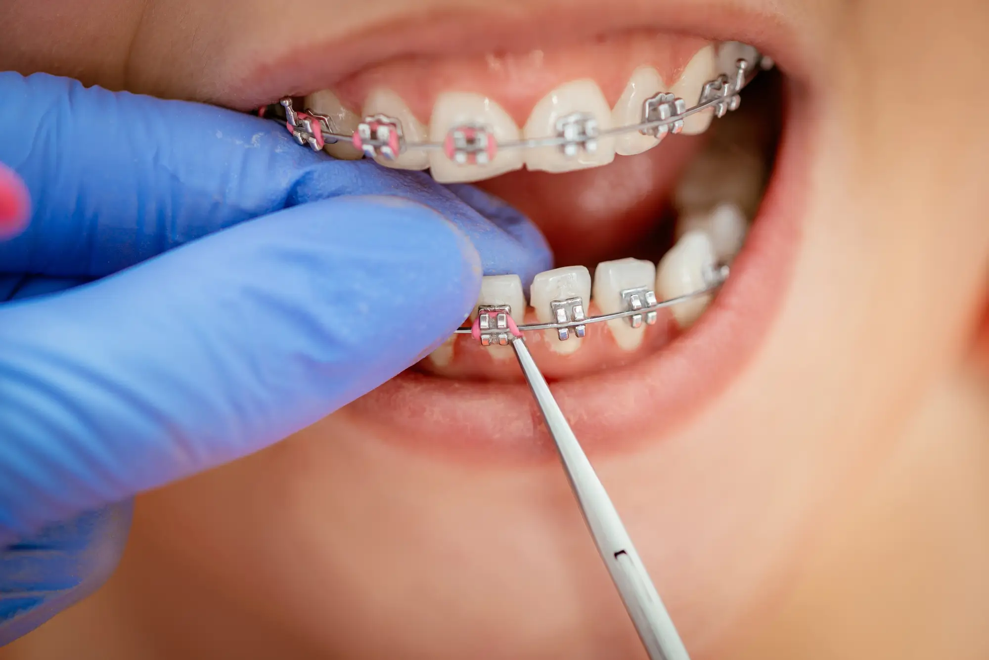 Bracket Checkup with Orthodontist in Quakertown