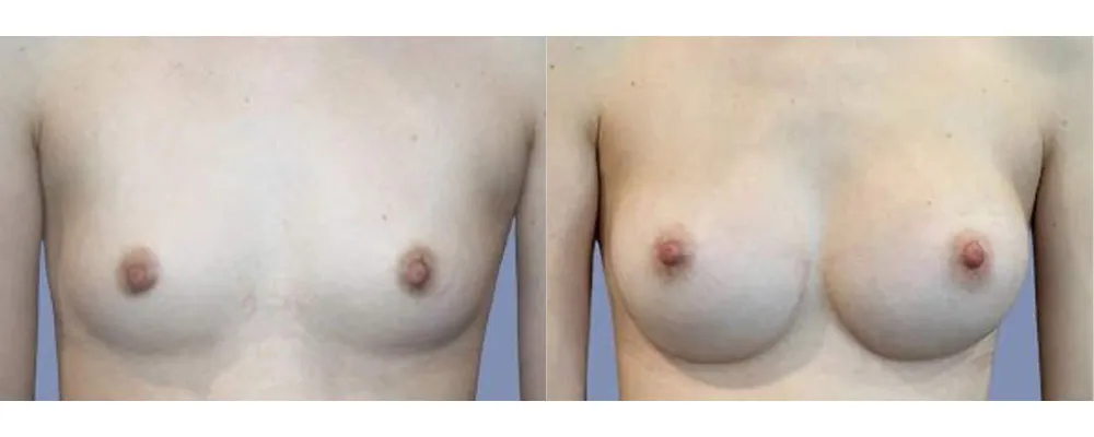 breast-augmentation