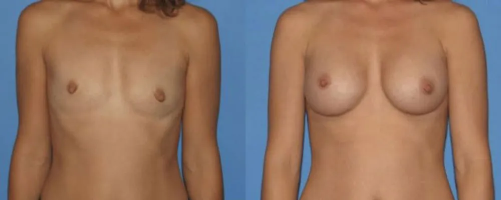 breast-augmentation