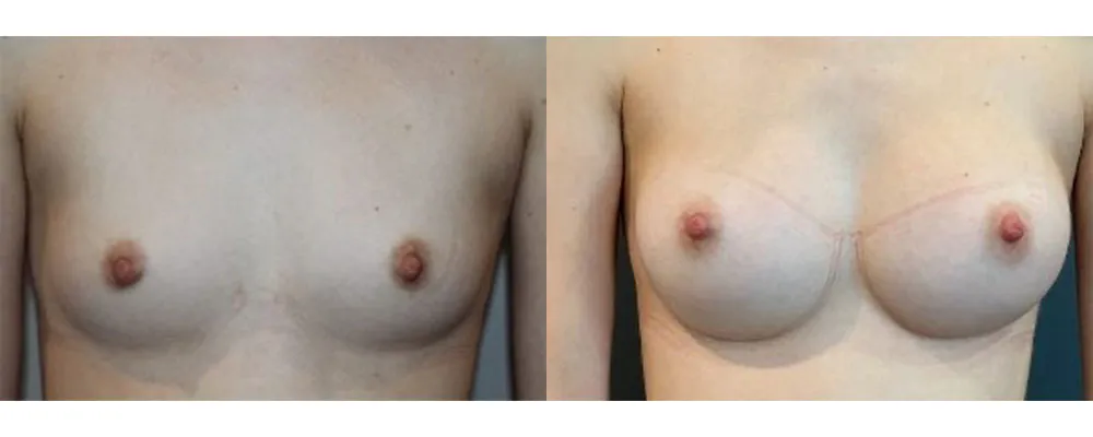 breast-augmentation