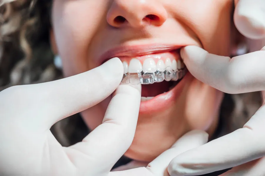 dentist-inserting-clear-aligner-on-patient