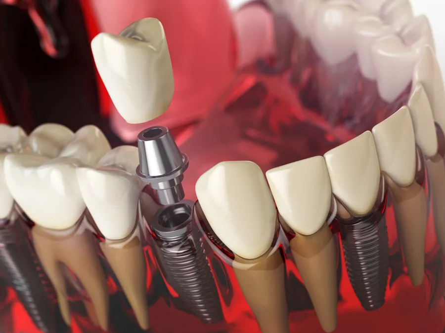 dental_implant_installation_process_with_model_tooth_and_implant
