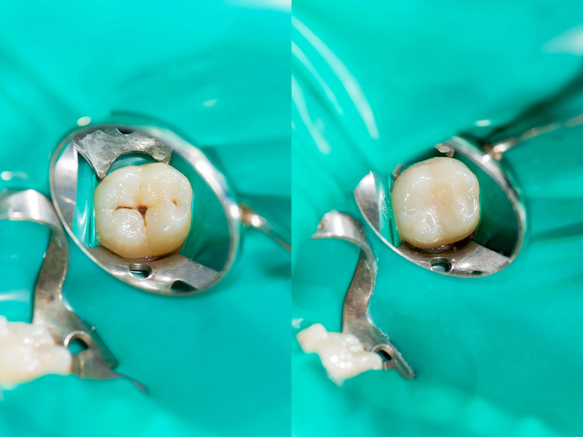dental-sealants-before-and-after-protective-treatment-18104