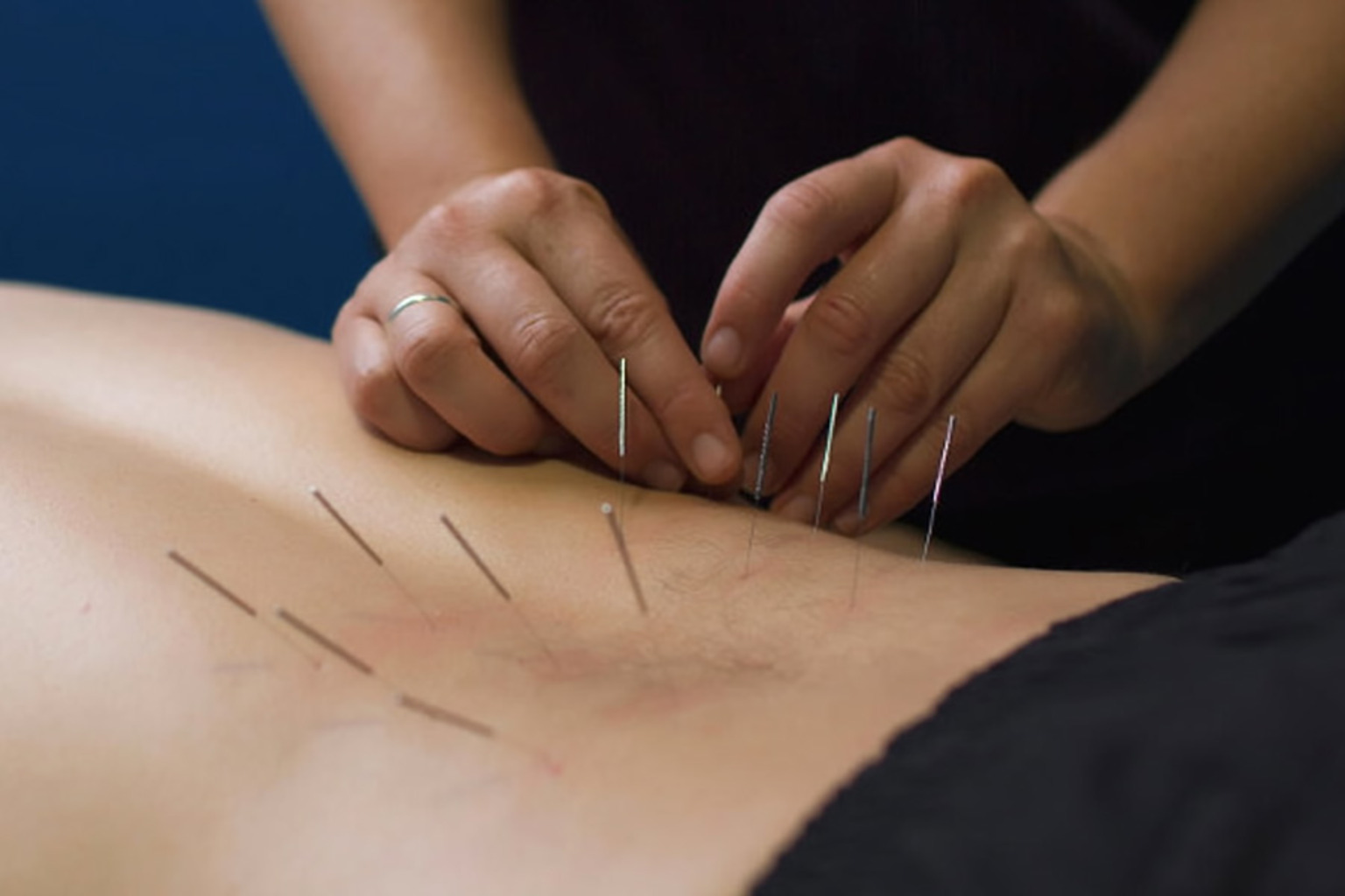 Dry Needling Therapy in Dubai: Effective Treatment for Muscle Pain and Movement Dysfunction