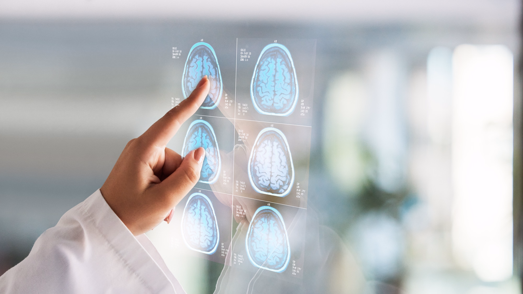 Pre-Alzheimer’s Detection Panel