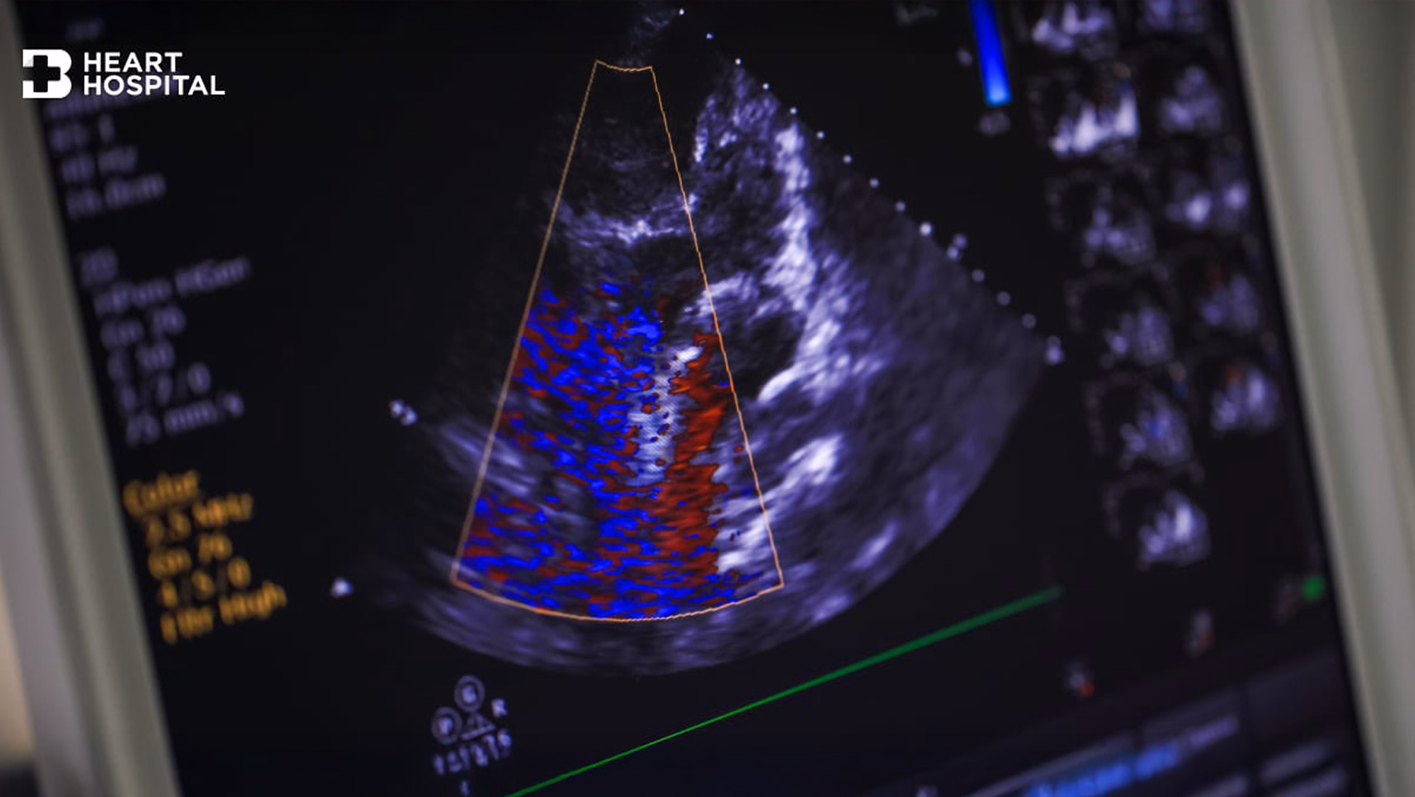 Echo Test (Echocardiogram)