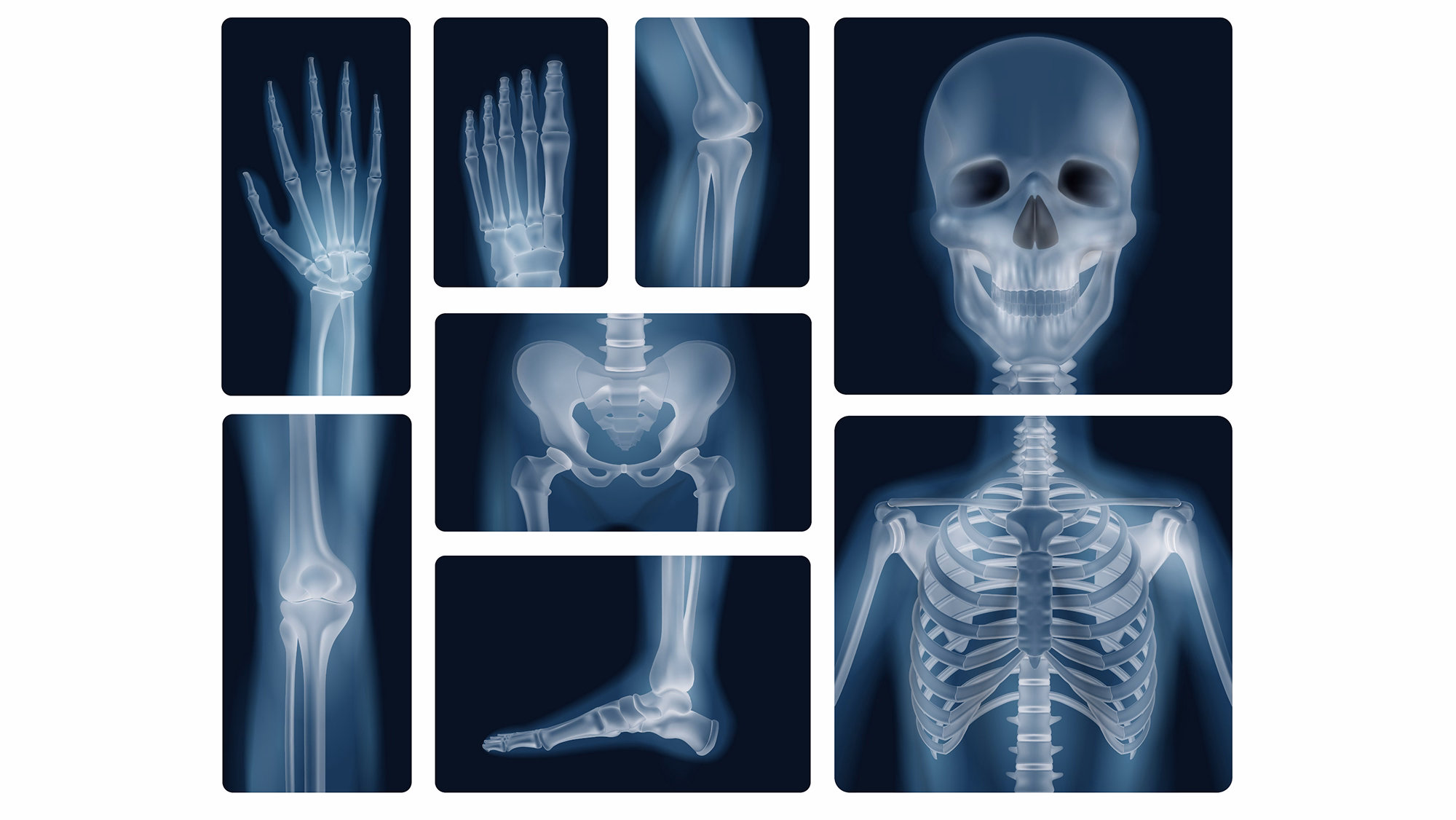 Bone Density Scan (DEXA)