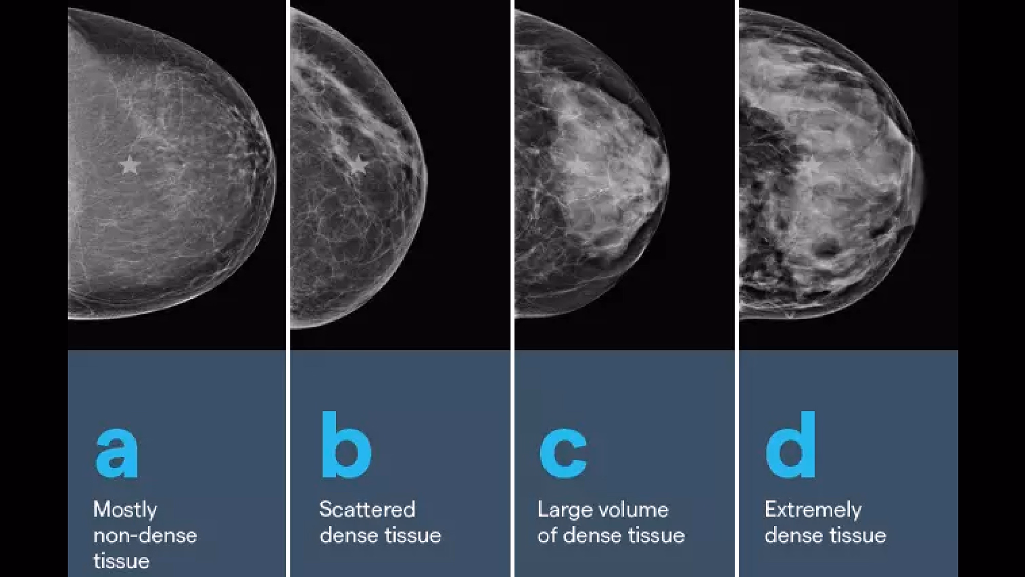 Mammogram Breast Female