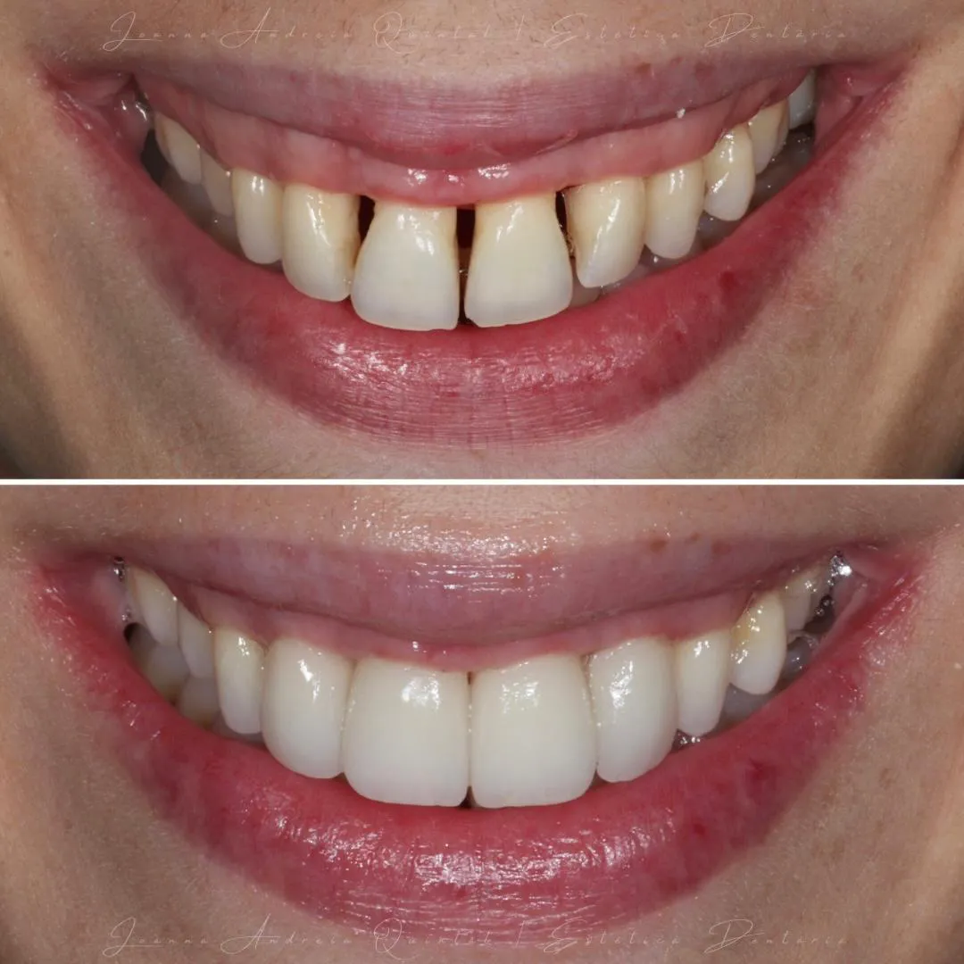Imagem comparativa mostrando um sorriso antes e depois do tratamento dental, com dentes frontais espaçados e amarelados na parte superior e dentes brancos, alinhados e uniformes na parte inferior.