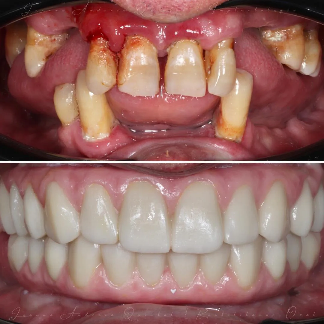 Imagem antes e depois mostrando dentes severamente danificados e gengivas inflamadas na parte superior, e dentes restaurados brancos e alinhados na parte inferior.