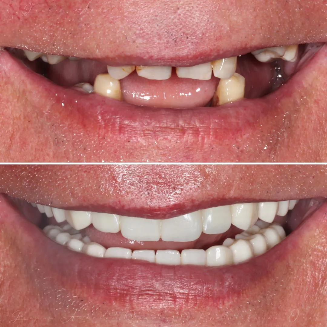 Foto em duas partes mostrando antes e depois de um tratamento dentário; na parte superior dentes com espaços e manchas amareladas, na inferior dentes brancos, retos e alinhados.