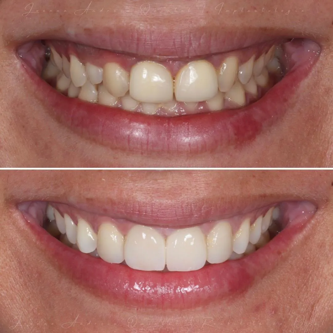 Imagem comparativa mostrando um sorriso antes e depois de tratamento odontológico, destacando dentes mais alinhados e brancos após o procedimento.