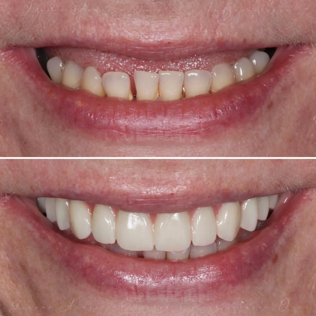 Comparação de antes e depois de um sorriso mostrando dentes superiores com melhorias na cor e alinhamento.