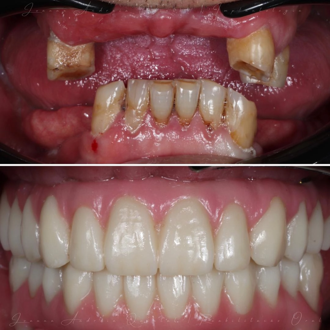Imagem comparativa mostrando dentes superiores severamente danificados na parte superior e dentes brancos perfeitamente restaurados na parte inferior.