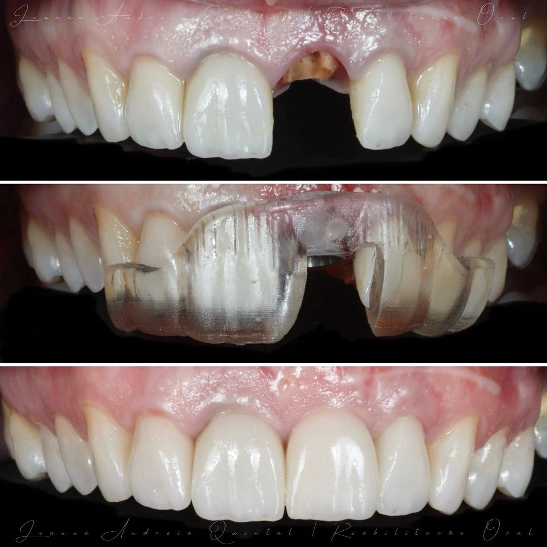 Sequência de três fotos mostrando reabilitação dental: dentes frontais antes com dente ausente, guia cirúrgico transparente no meio, e dentes restaurados após o tratamento.