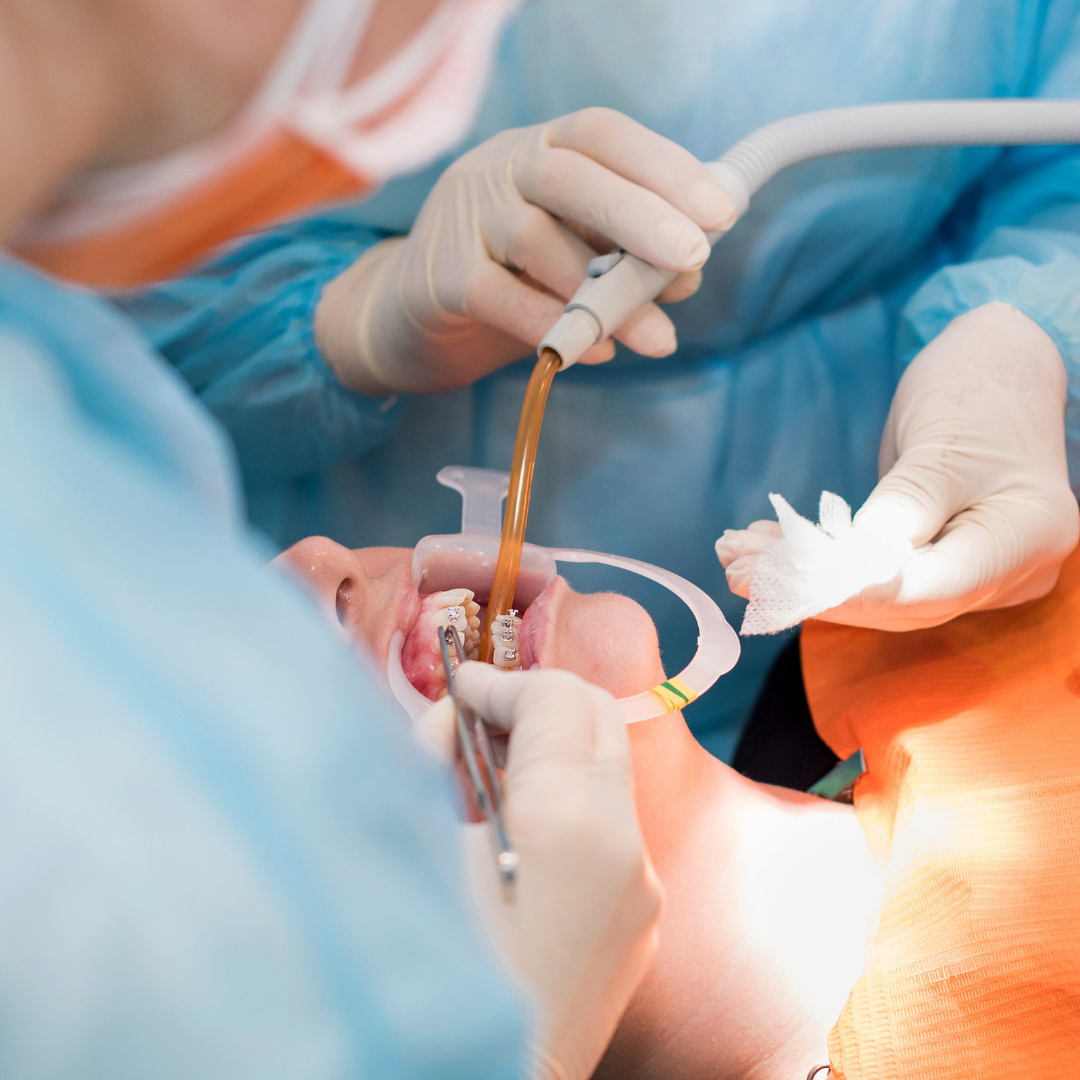 Dentista realizando procedimento odontológico em paciente com aparelho ortodôntico, usando ferramentas e sucção na boca.