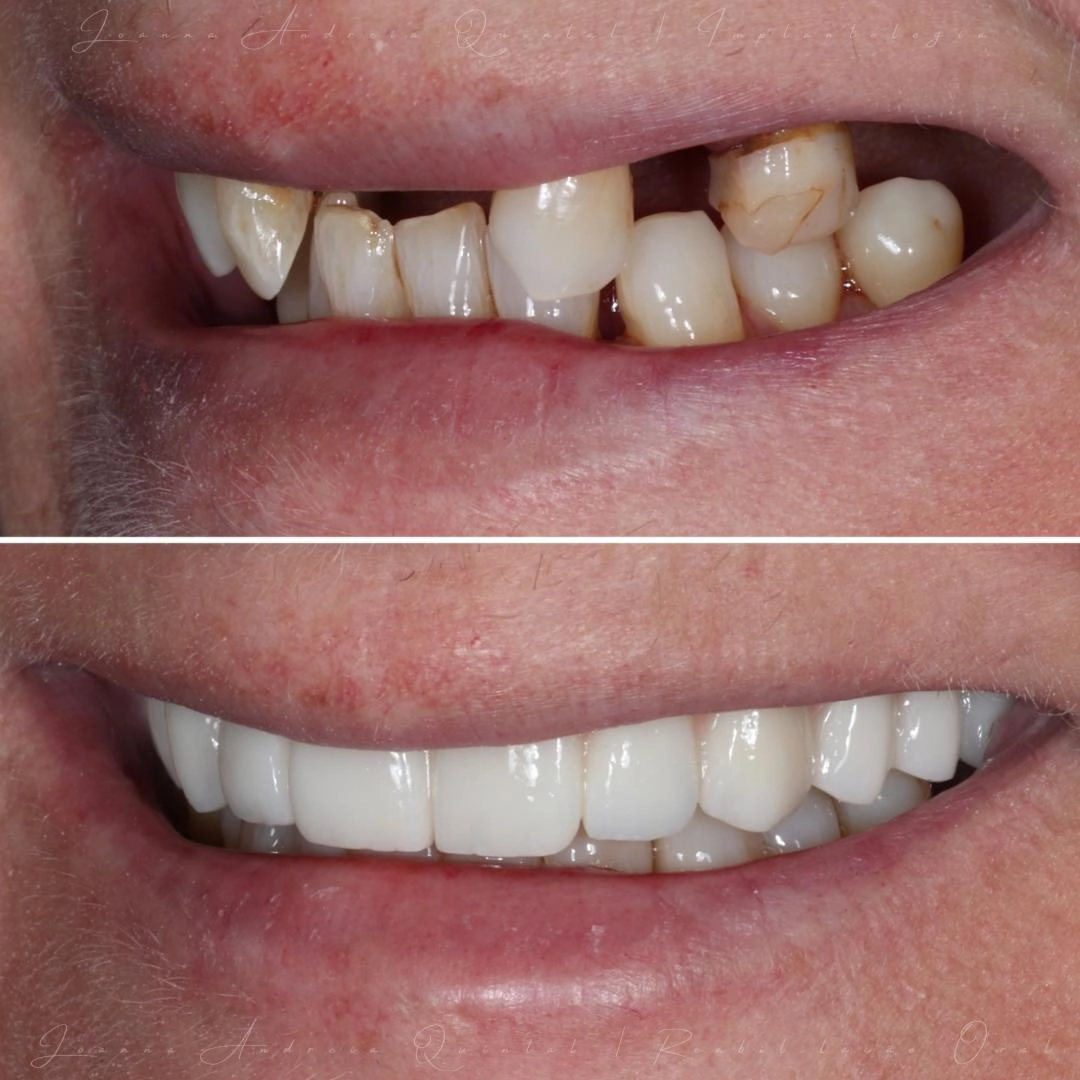 Imagem comparativa de antes e depois mostrando os dentes superiores danificados e amarelados no topo e os dentes restaurados, alinhados e brancos na parte inferior.