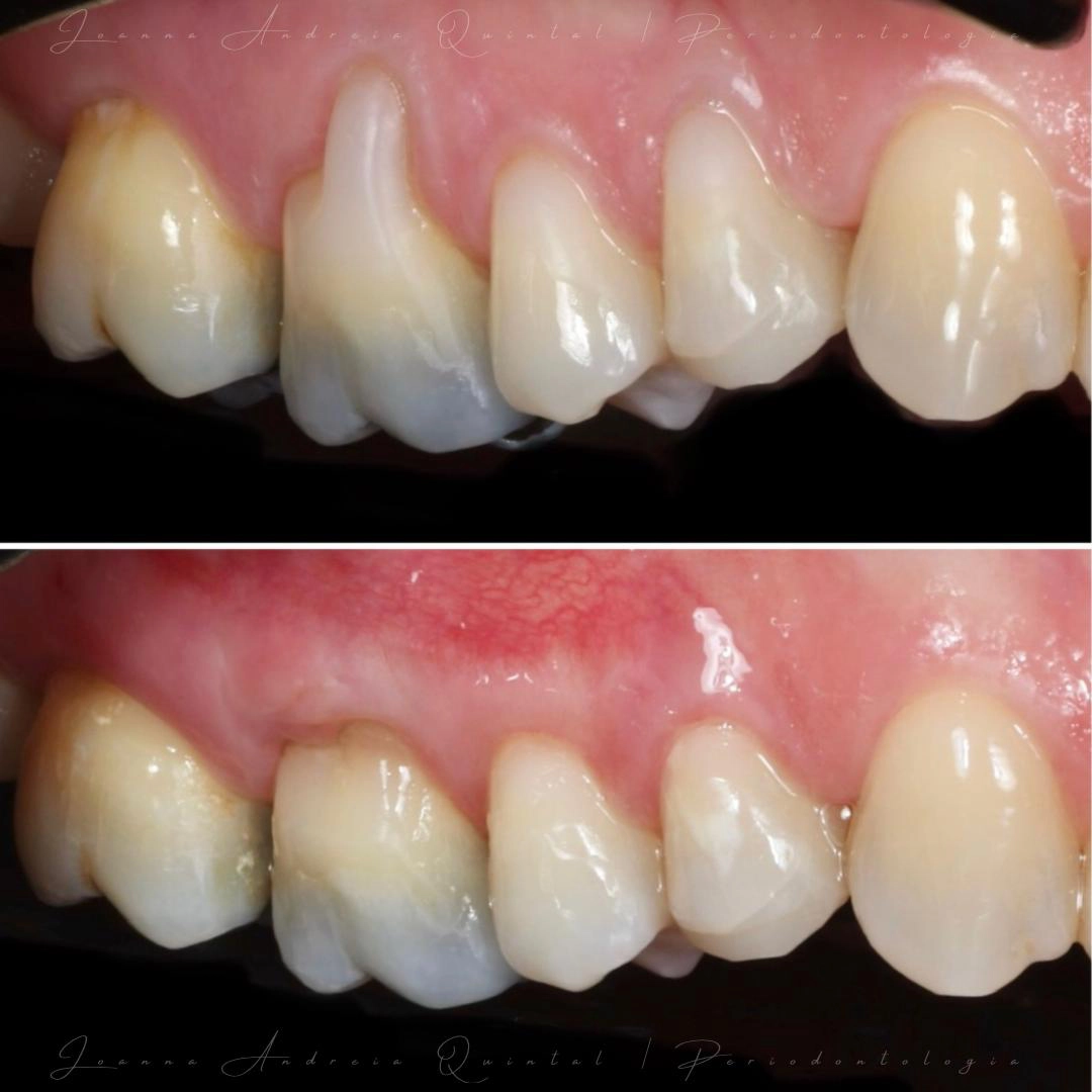 Imagem de close-up mostrando dentes com retração gengival antes e depois do tratamento periodontal.