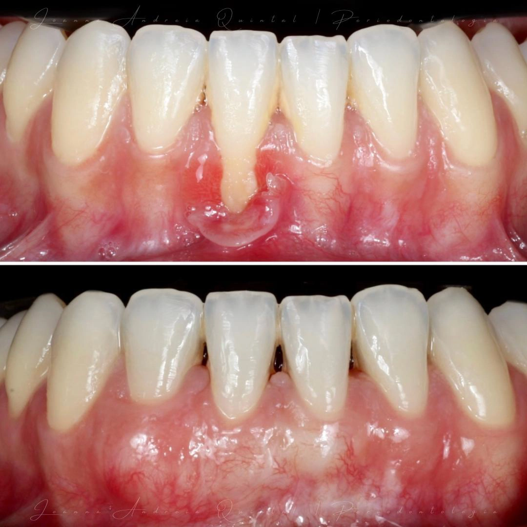 Imagem comparativa mostrando gengiva inflamada e lesionada com pus entre os dentes frontais superiores na parte superior e gengiva saudável e cicatrizada na parte inferior.