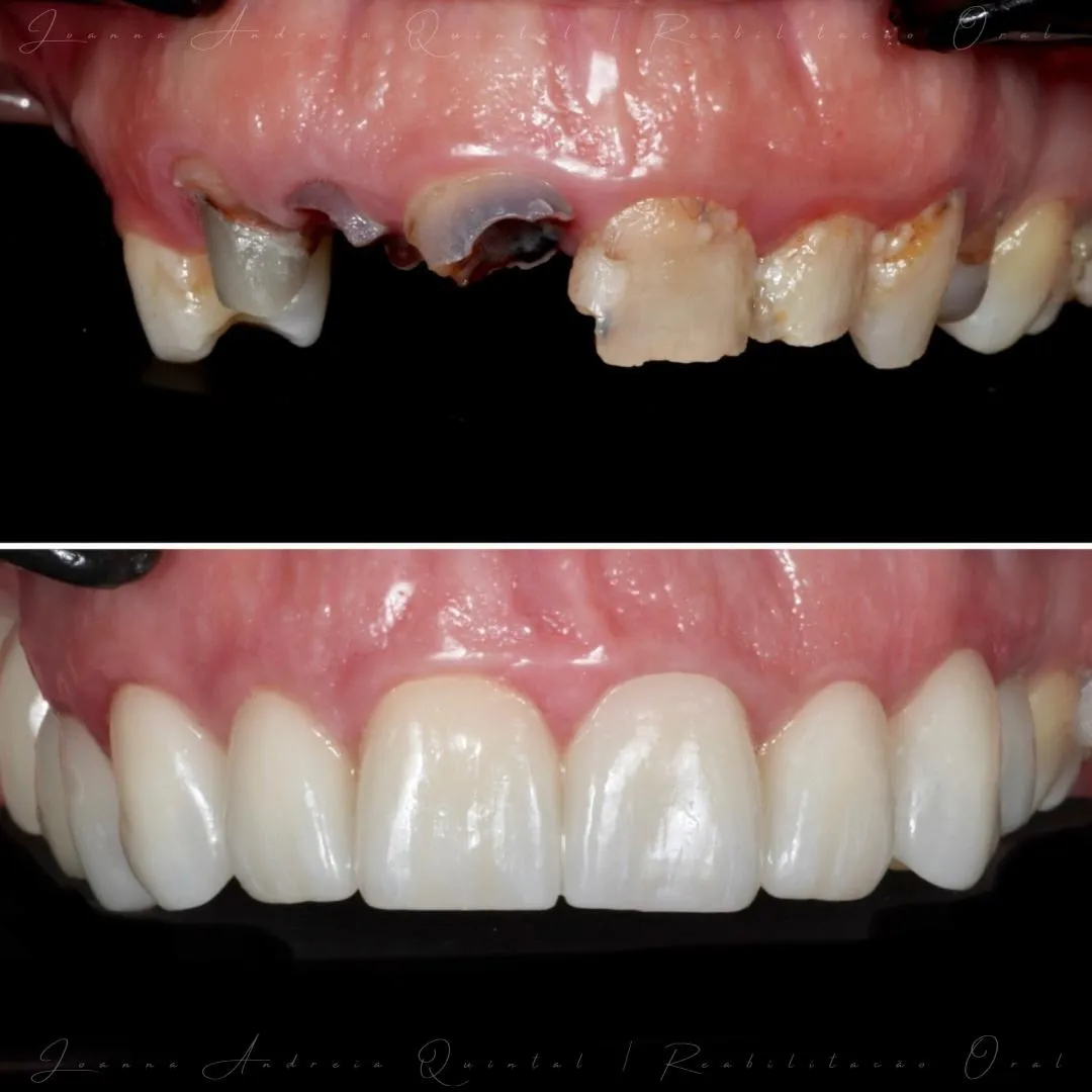 Antes e depois da reabilitação oral mostrando dentes superiores severamente danificados e sua restauração completa com dentes brancos e alinhados.