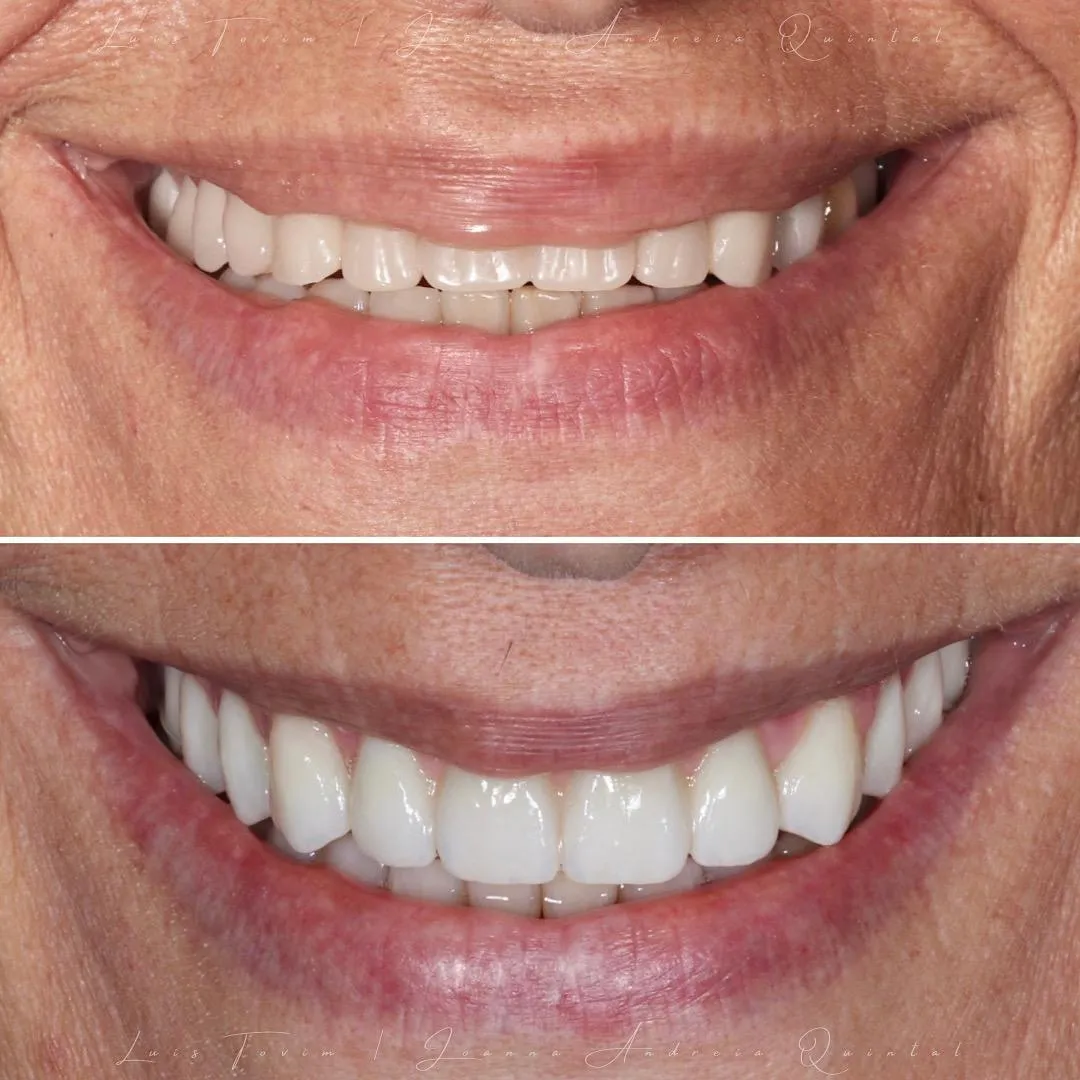 Comparação de sorriso antes e depois com dentes visivelmente mais brancos e alinhados na imagem de baixo.