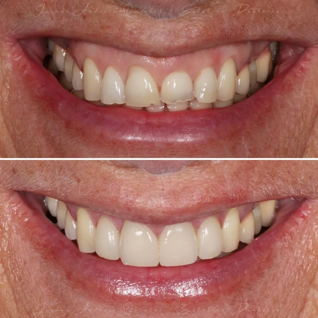 Antes e depois de reabilitação estética com facetas dentárias, mostrando a melhoria da forma, cor e harmonia do sorriso.
