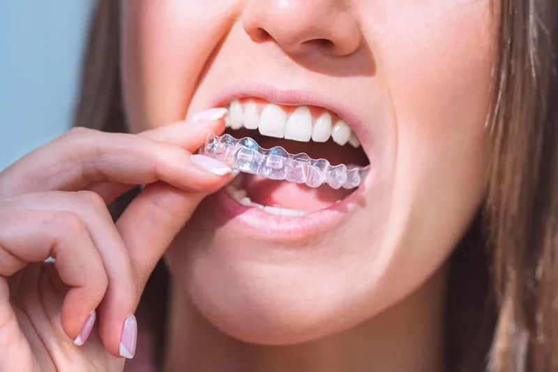 Women placing clear aligners on her teeth