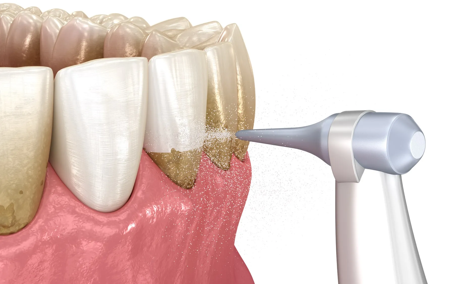 Dental cleaning tool spraying water to remove plaque and tartar buildup from teeth near the gum line.