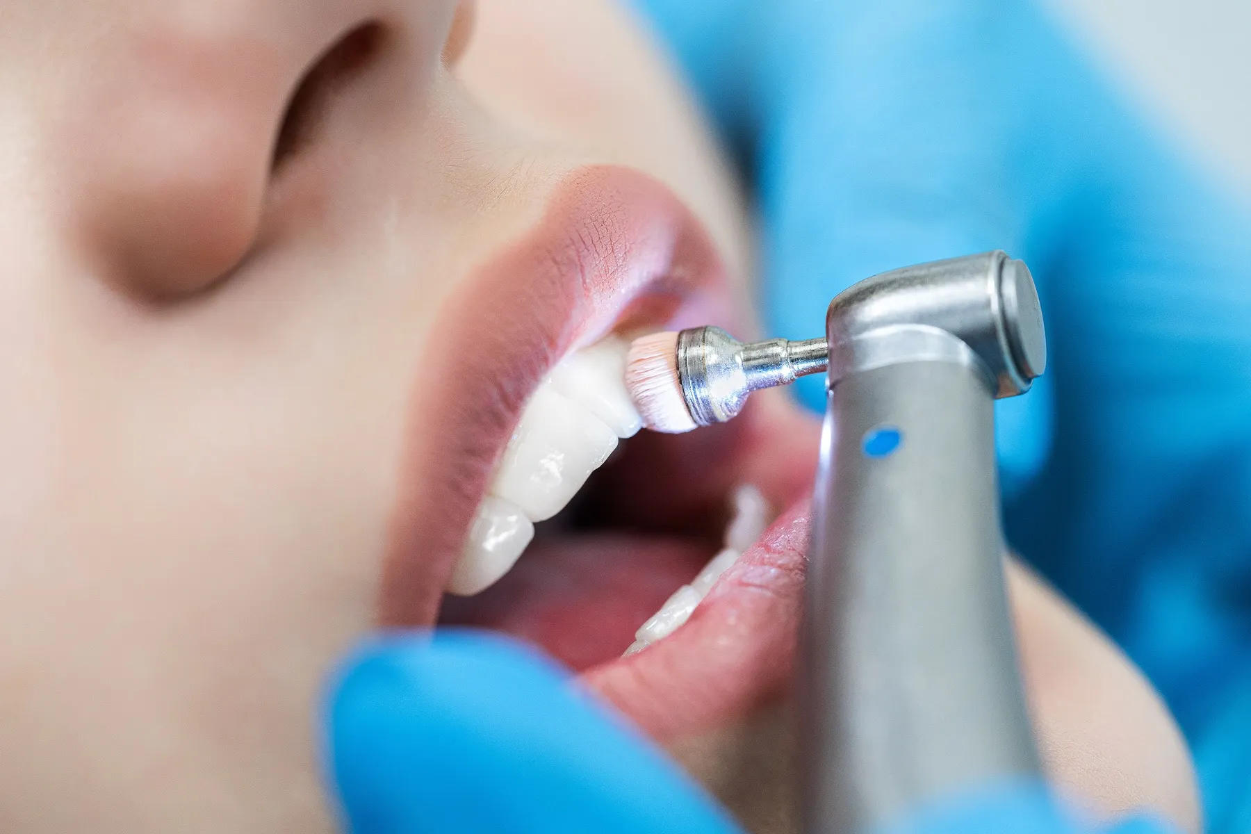 Close-up of a dental cleaning with a polishing tool on white teeth and lips.