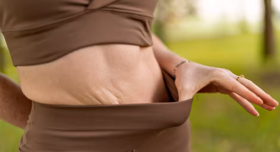 The Truth About Loose Skin After Weight Loss on GLP-1