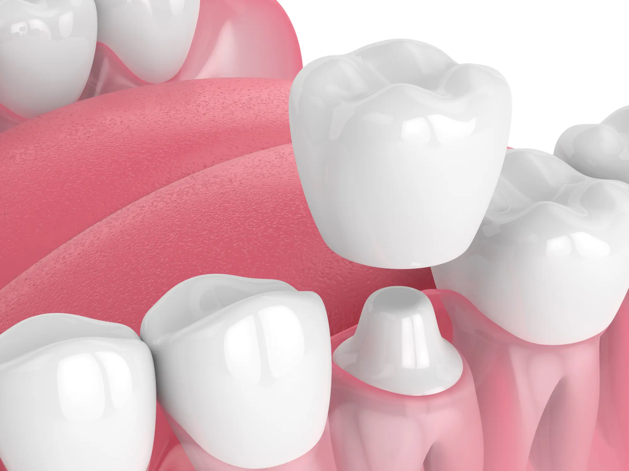 Implant Crown vs. Traditional Crown: What’s the Difference?