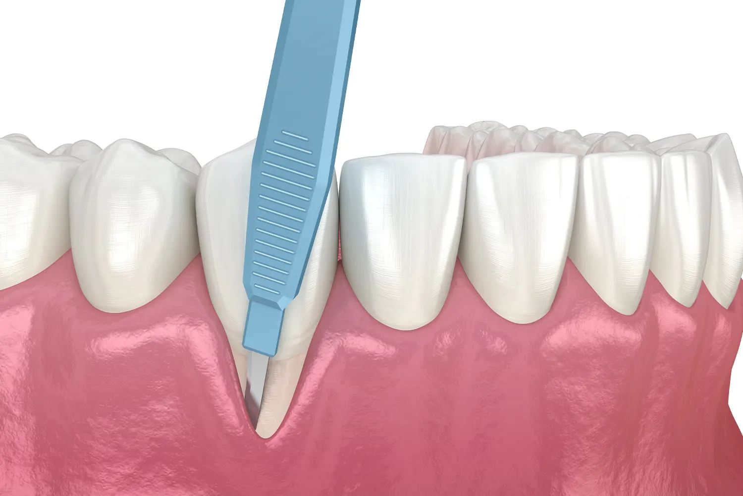 Can Treating Gum Disease Reduce the Risk of Heart Disease and Diabetes?