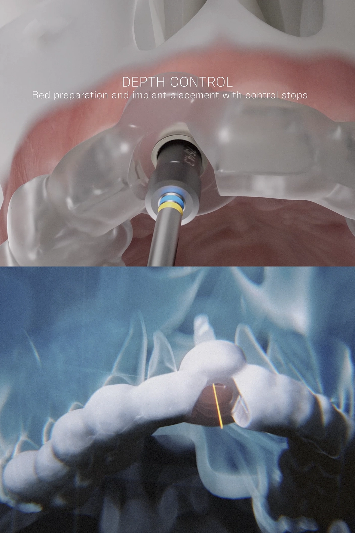Neodent Zi Guided