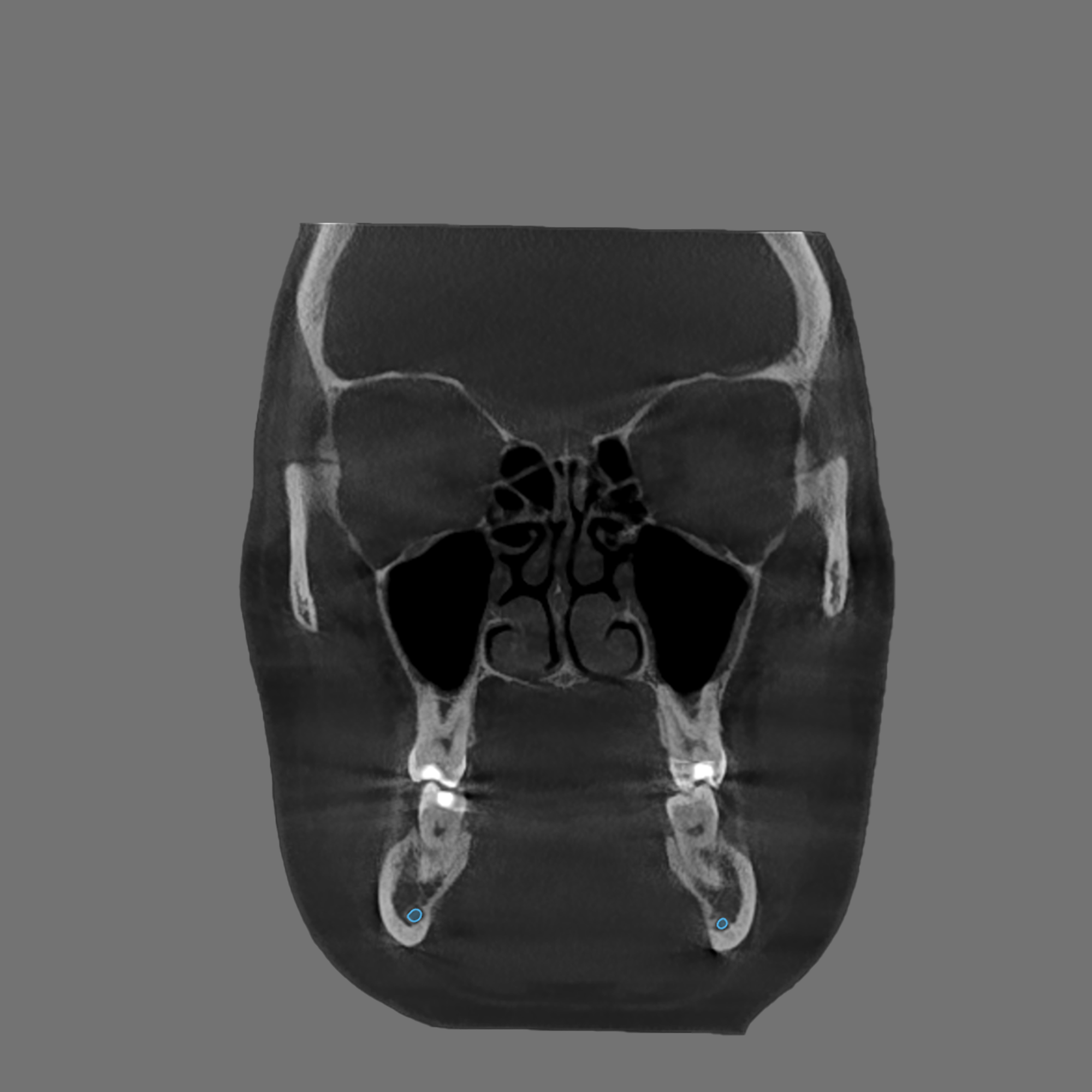 Coronal CBCT scan showing healthy sinus cavities and jawbone structure with dental restorations visible.