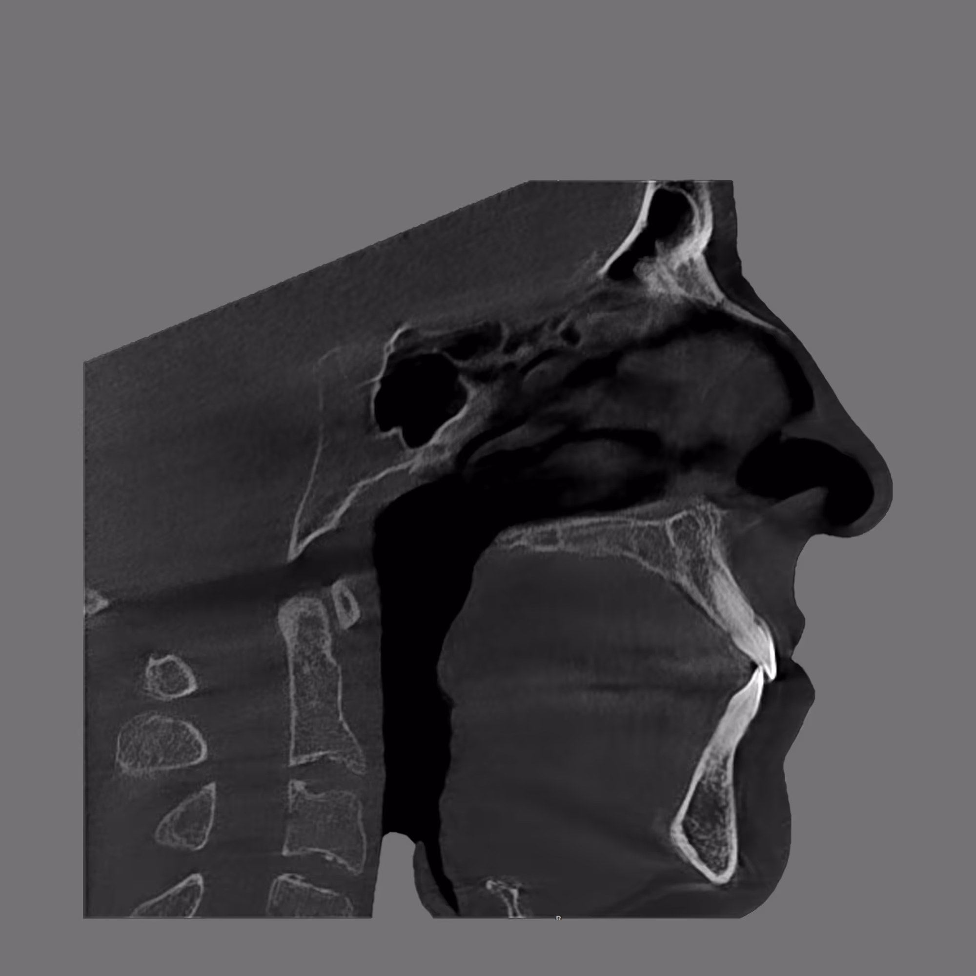 Sagittal CBCT scan showing skull and airway passage with tongue posture.