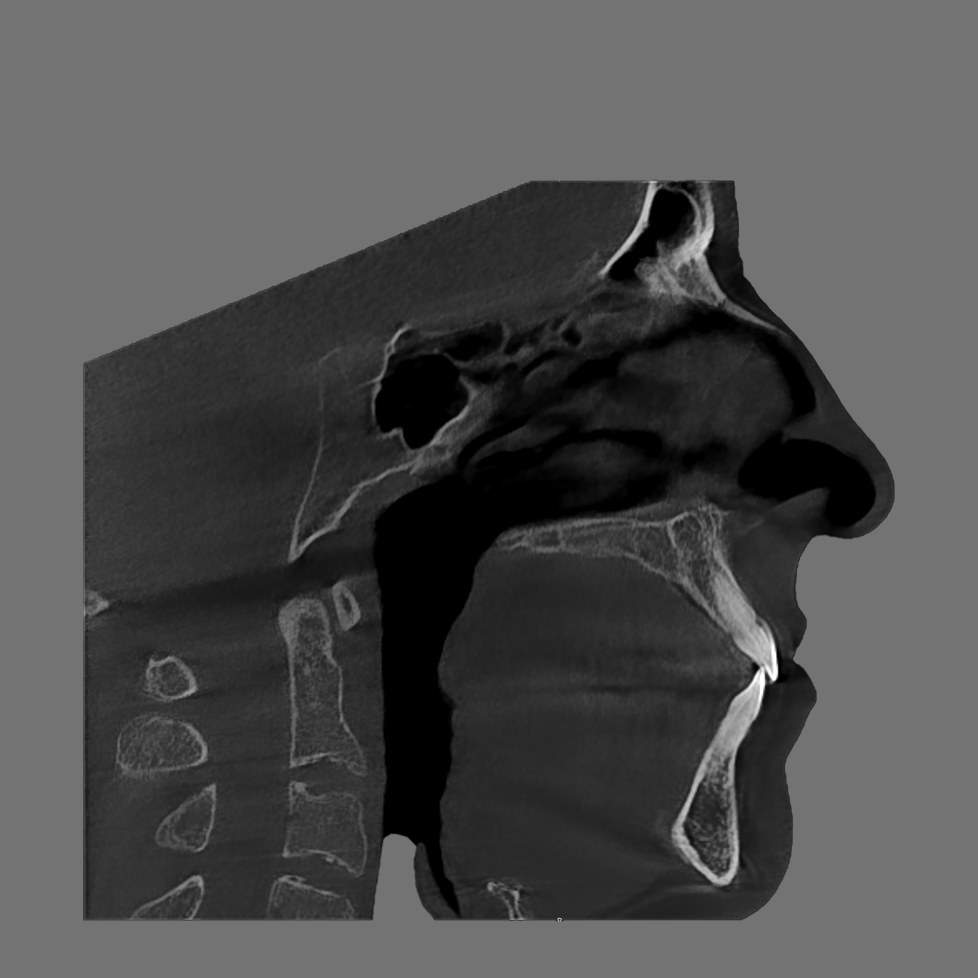 Sagittal CBCT scan showing skull and airway passage with tongue posture.
