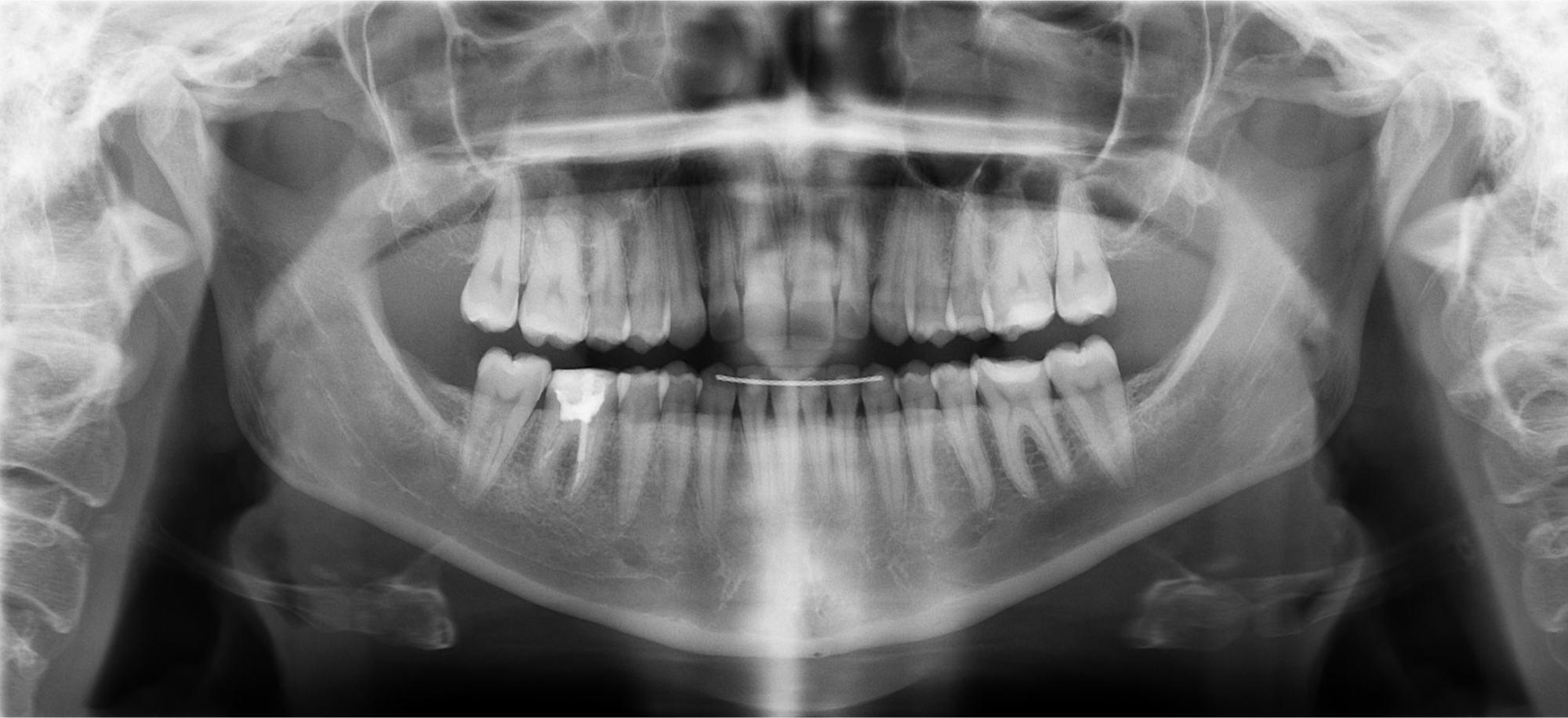 Panoramic dental X-ray showing full set of upper and lower teeth, jawbone, and a dental filling on a lower molar.