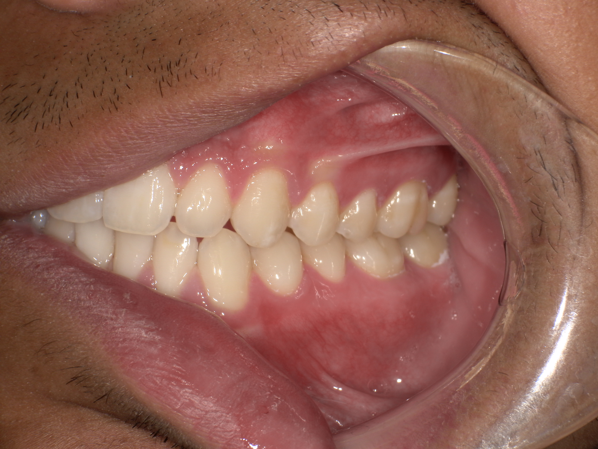Close-up of a person’s mouth showing upper and lower teeth with a dental cheek retractor.