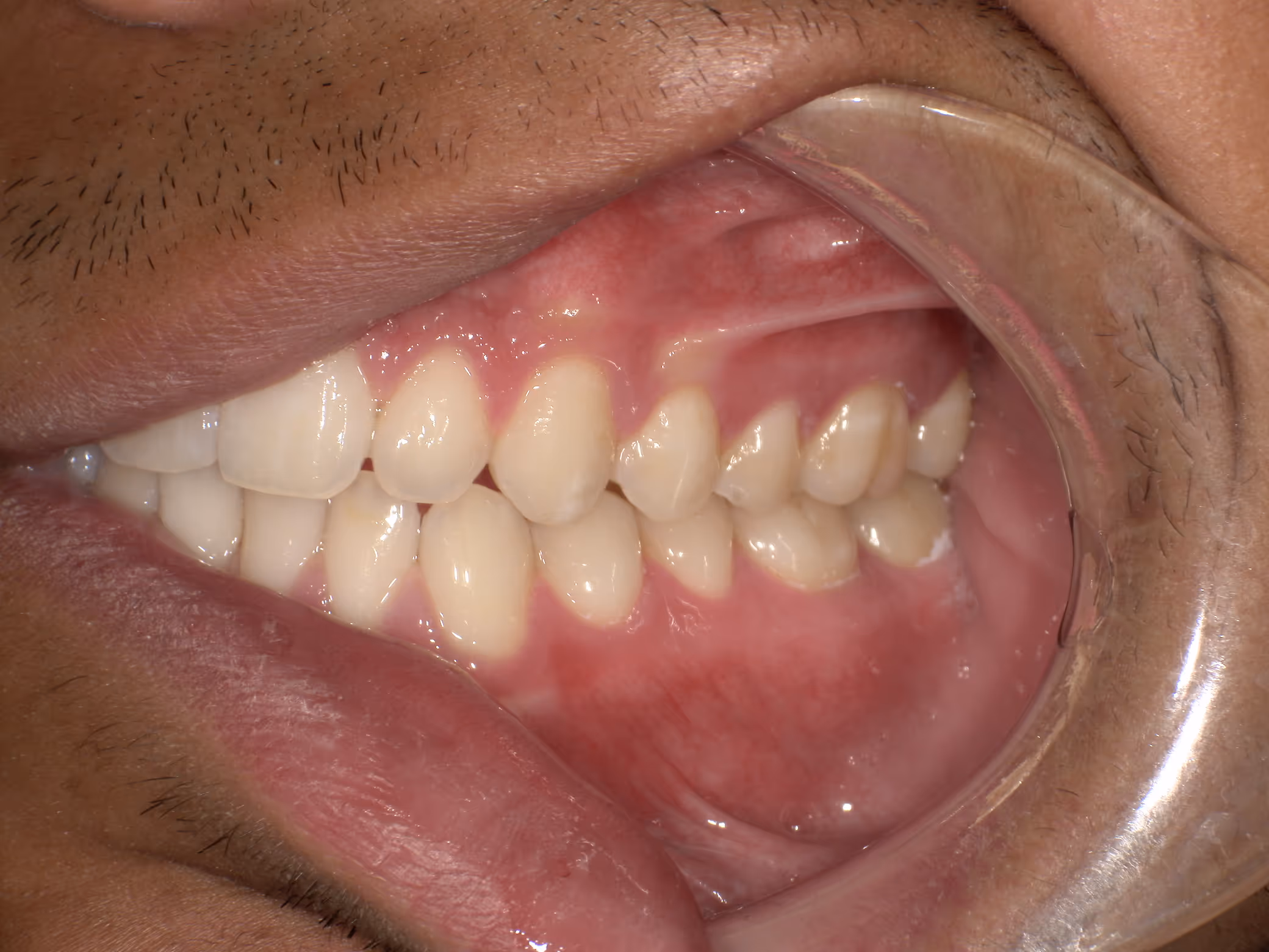 Close-up of a person’s mouth showing upper and lower teeth with a dental cheek retractor.