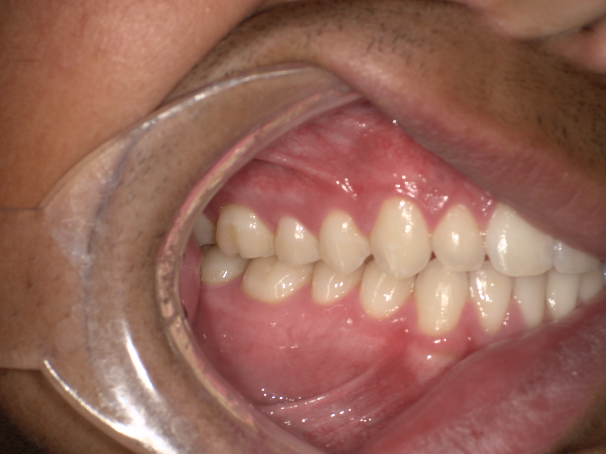 Close-up of a person's lower and upper teeth and gums with a dental cheek retractor.
