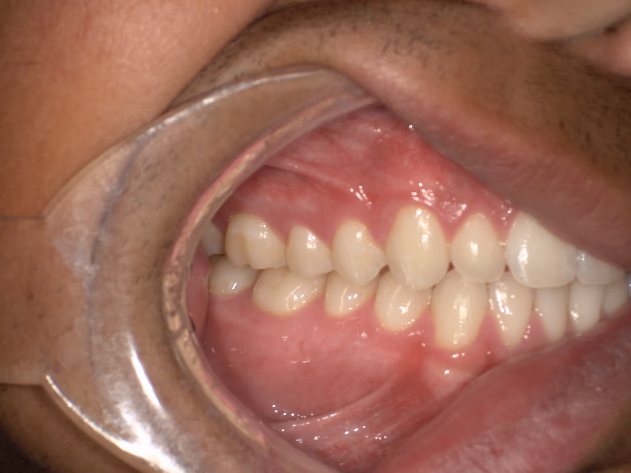 Close-up of a person's lower and upper teeth and gums with a dental cheek retractor.