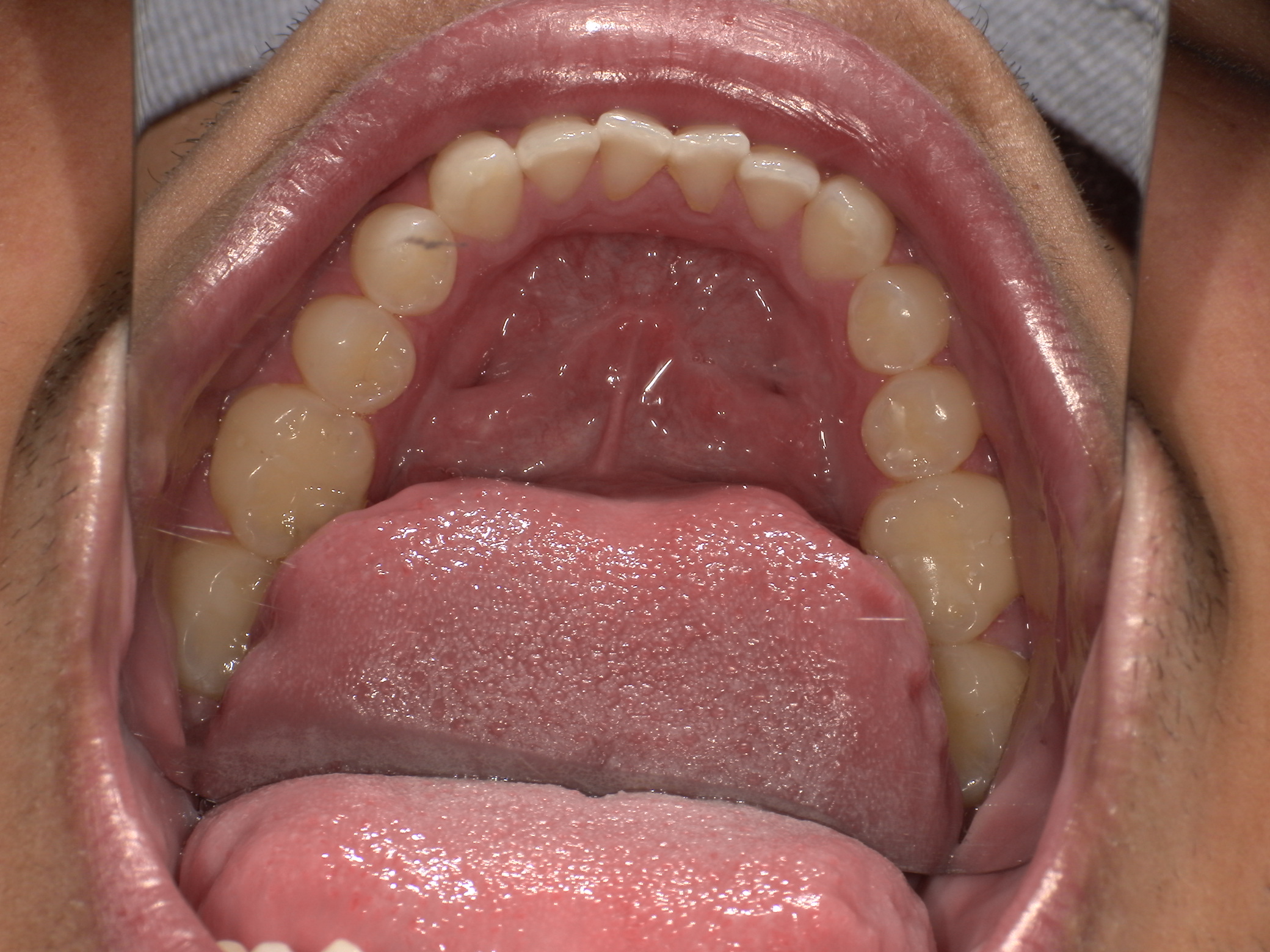 Close-up view inside an open mouth showing upper teeth, pink tongue, and roof of the mouth.