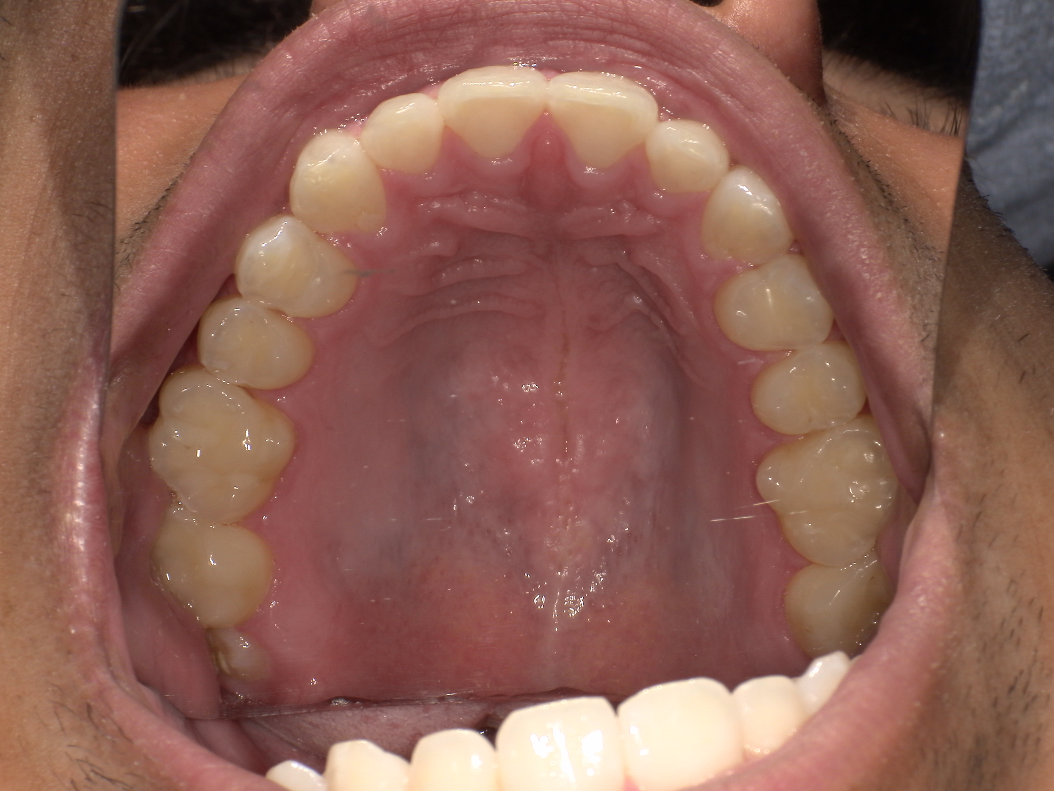 Close-up view inside an open mouth showing upper teeth, gums, and the roof of the mouth.