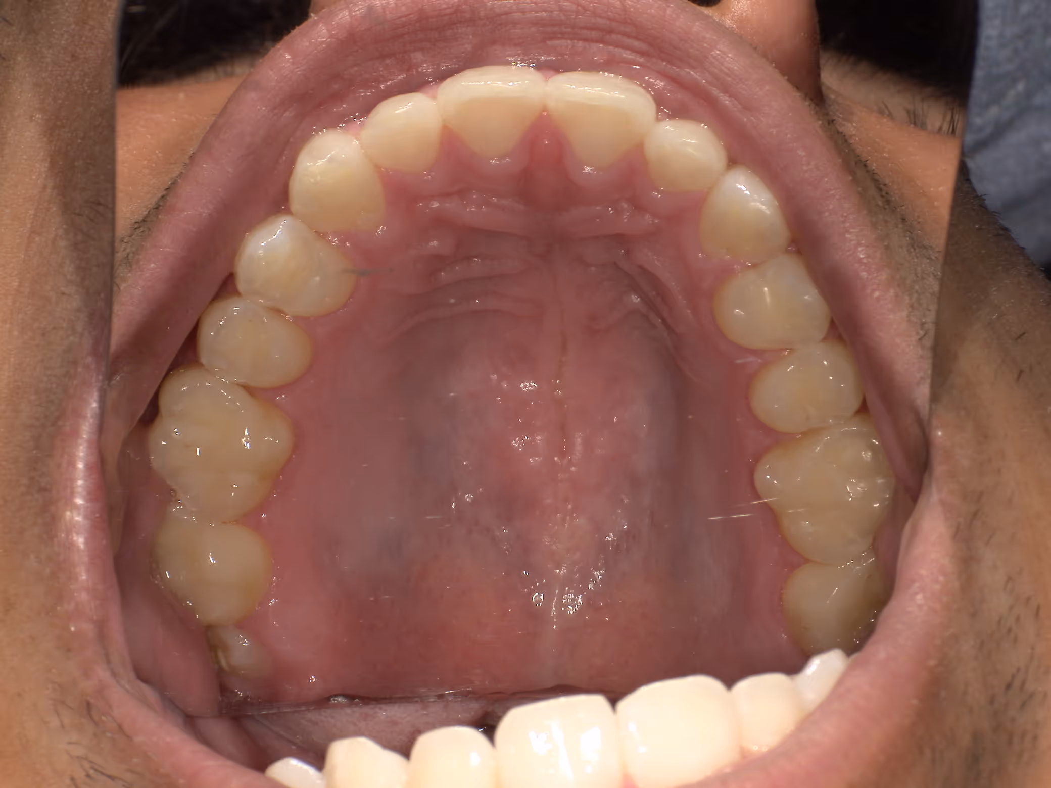 Close-up view inside an open mouth showing upper teeth, gums, and the roof of the mouth.