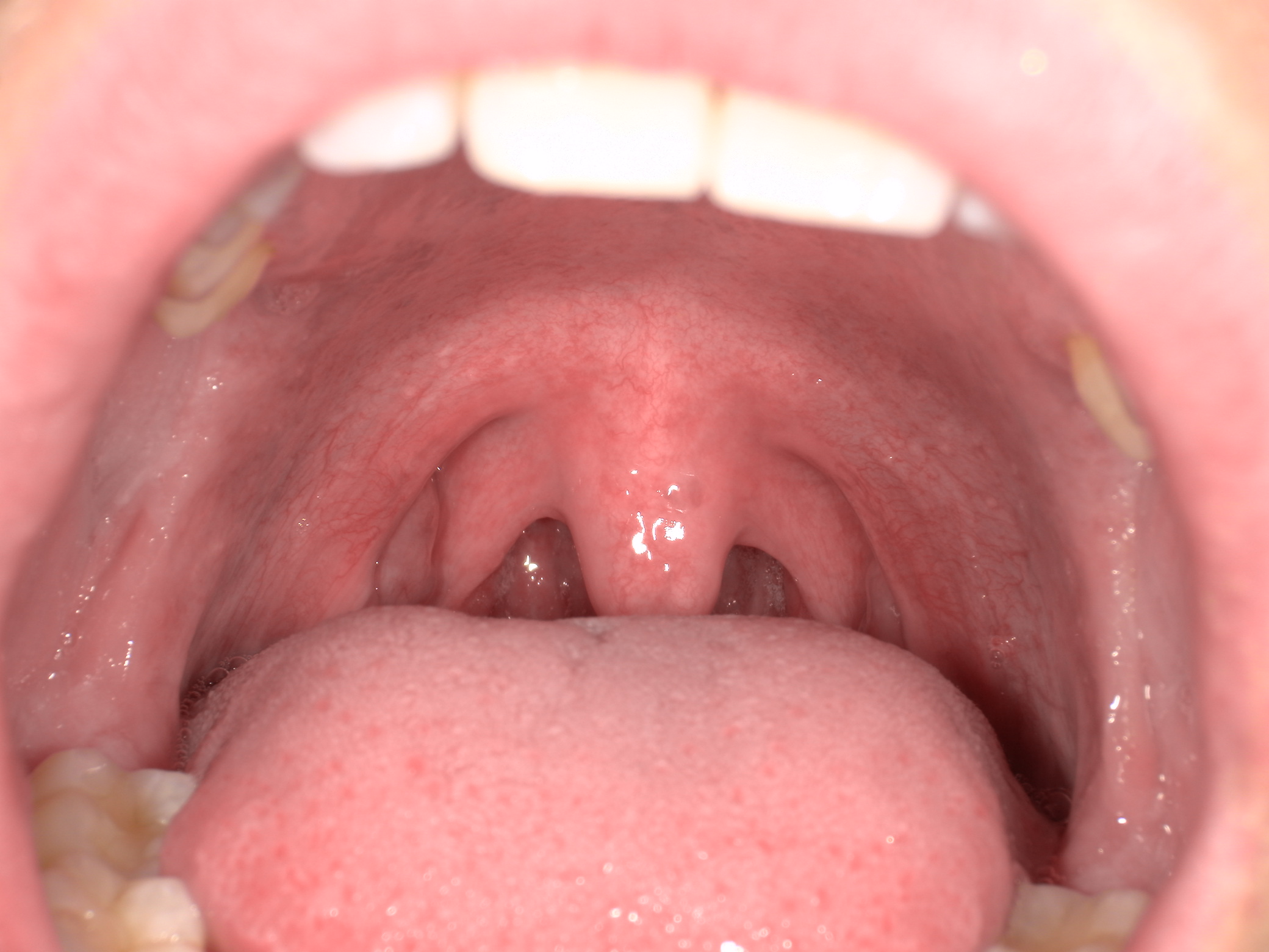 Close-up view inside a mouth showing the tongue, uvula, and surrounding throat tissues.
