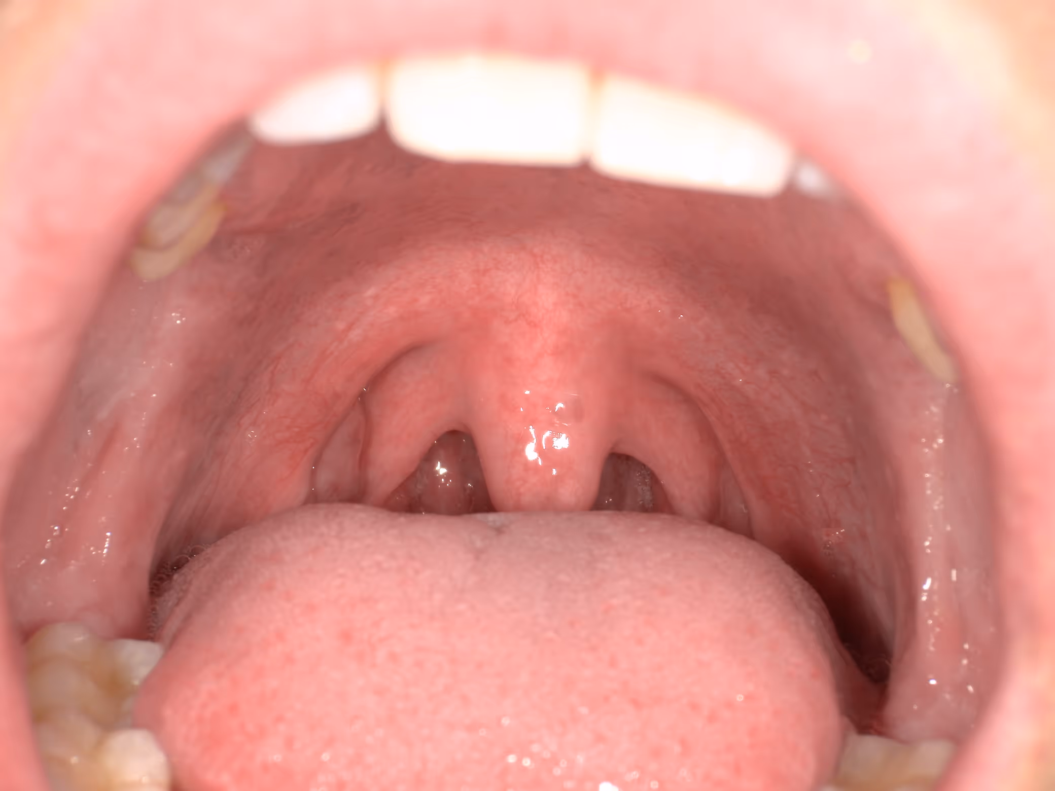 Close-up view inside a mouth showing the tongue, uvula, and surrounding throat tissues.