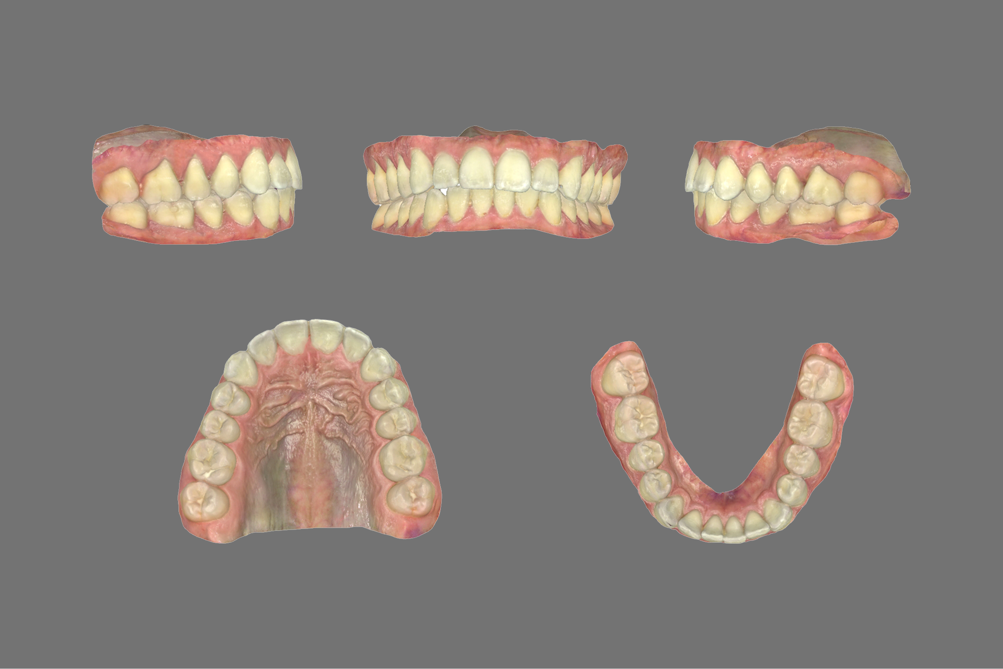 Five views of a dental impression showing upper and lower teeth and gums from frontal, side, and occlusal perspectives.