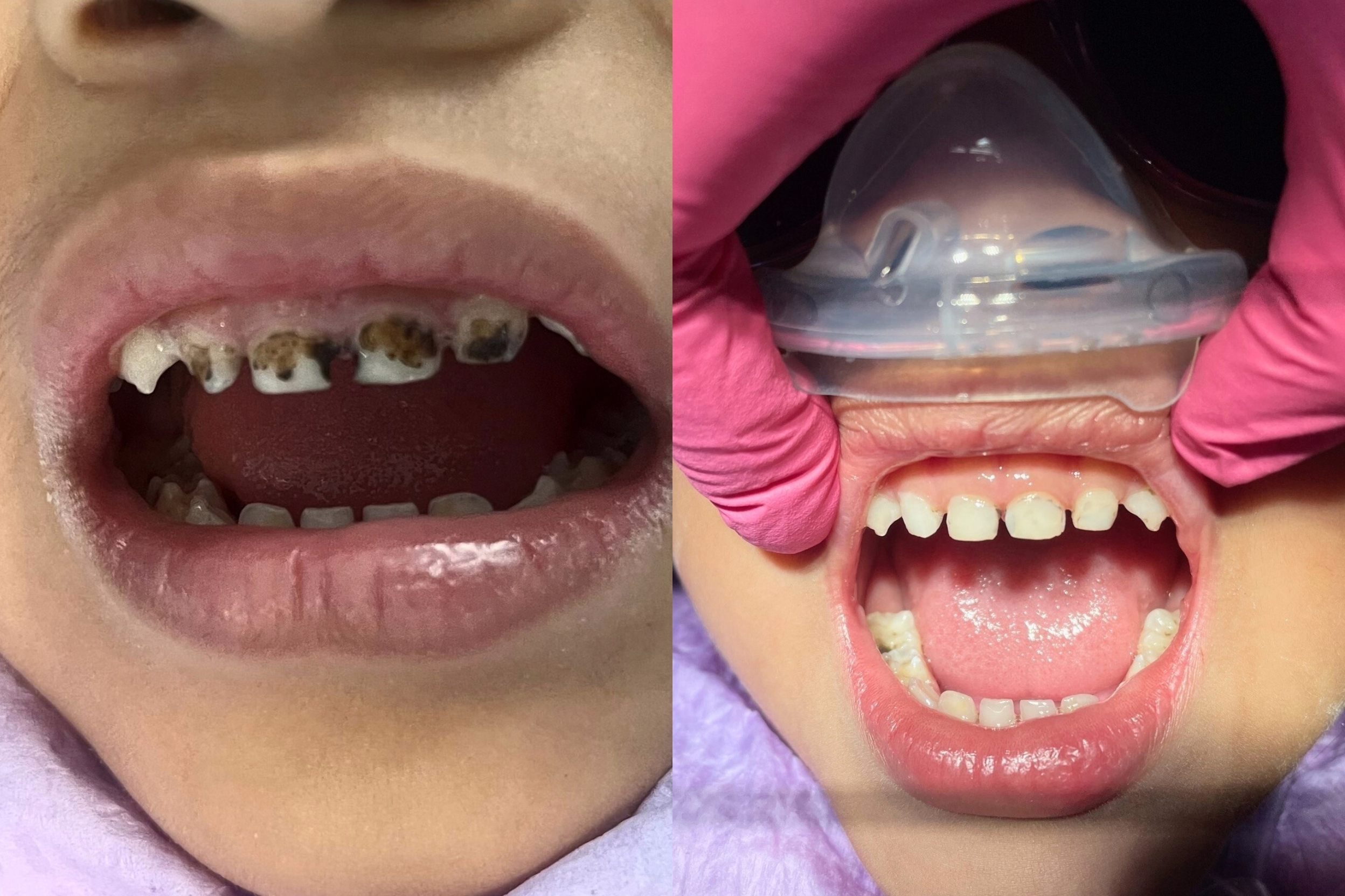 Side-by-side close-up of a child's open mouth showing severe tooth decay on the left and cleaned teeth on the right with a dental device and hands in pink gloves.