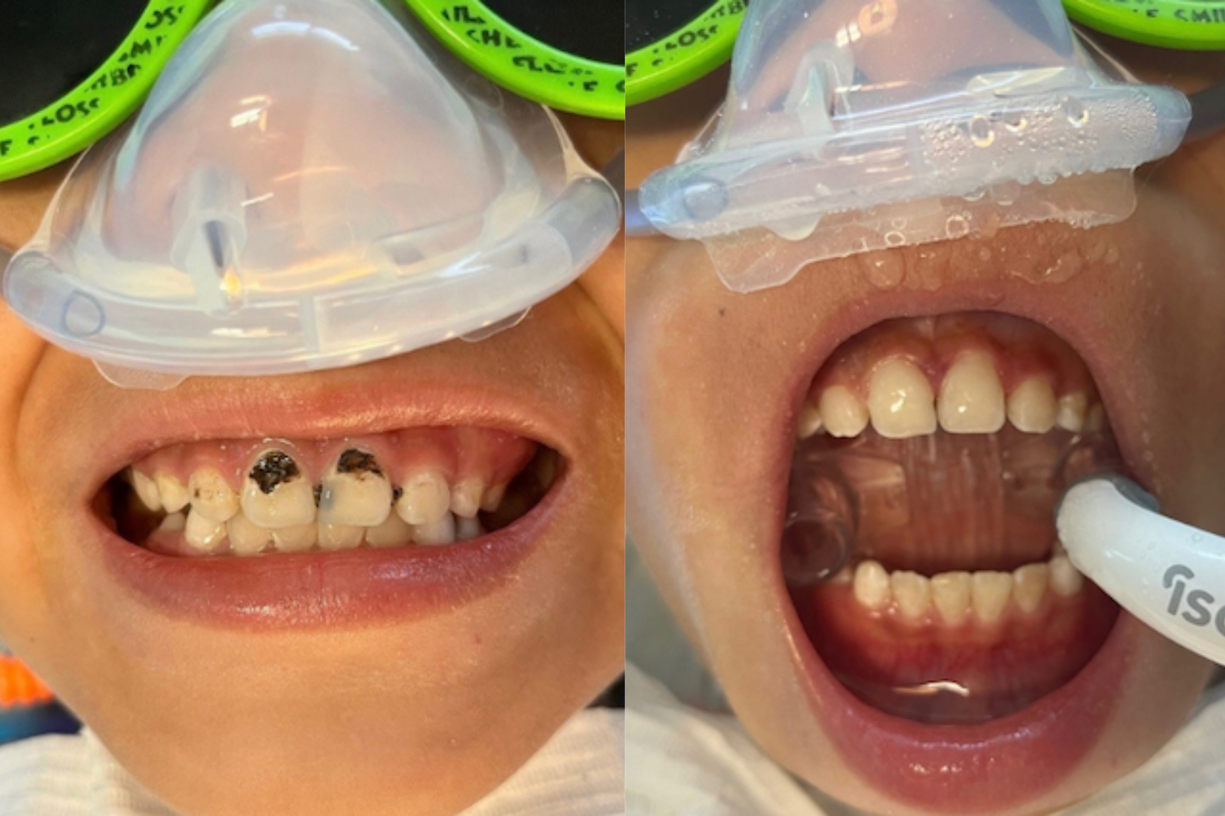 Side-by-side images of a child's teeth before and after dental treatment; left shows teeth with cavities, right shows clean teeth with a dental tool inserted.